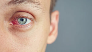 Glassy Eyes From Alcohol Abuse